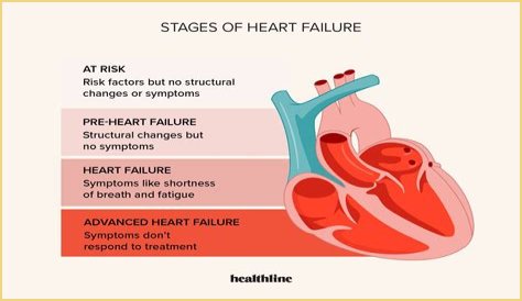 Heart Failure And The Plight Of Extreme Obesity